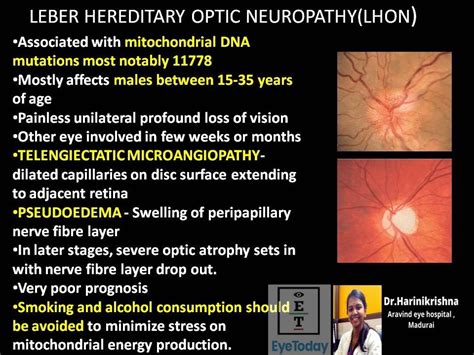 Giving Hope to Those Struggling with Leber Hereditary Optic Neuropathy: Finding an Experienced Low Vision Optometrist